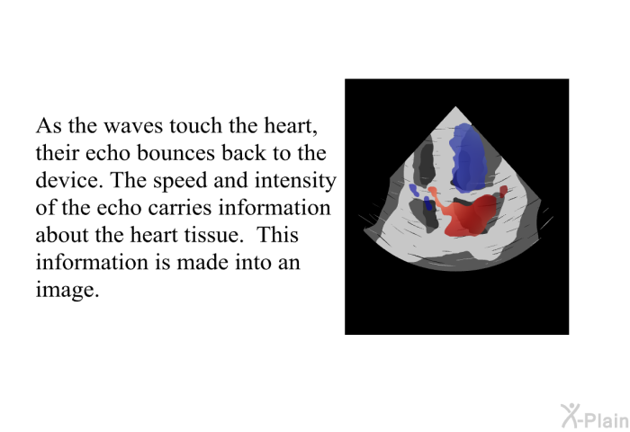 As the waves touch the heart, their echo bounces back to the device. The speed and intensity of the echo carries information about the heart tissue. This information is made into an image.