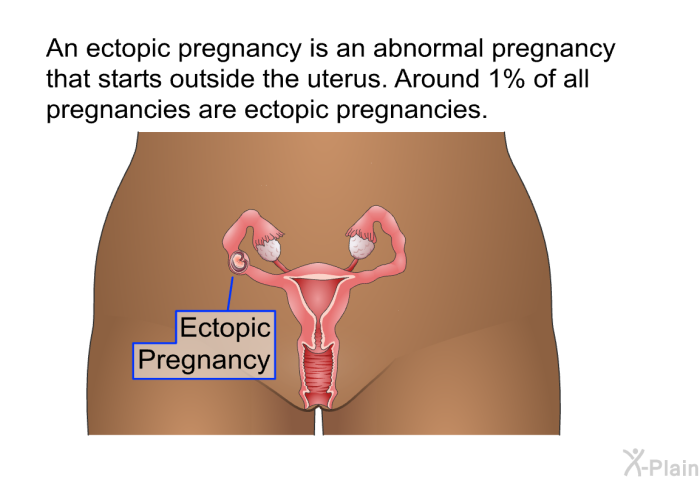 An ectopic pregnancy is an abnormal pregnancy that starts outside the uterus. Around 1% of all pregnancies are ectopic pregnancies.