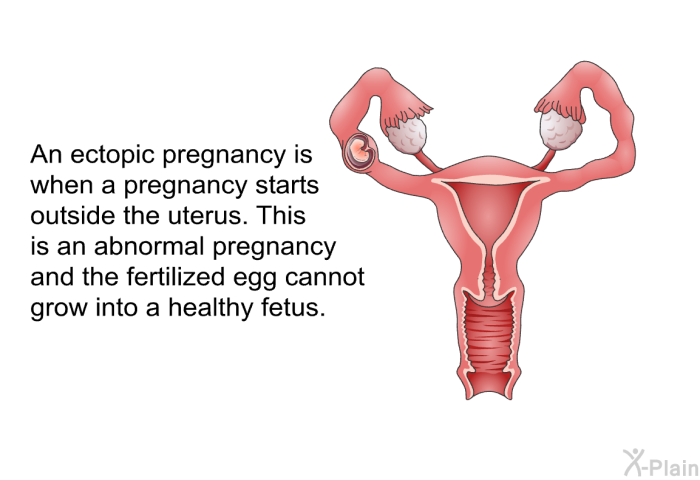 An ectopic pregnancy is when a pregnancy starts outside the uterus. This is an abnormal pregnancy and the fertilized egg cannot grow into a healthy fetus.
