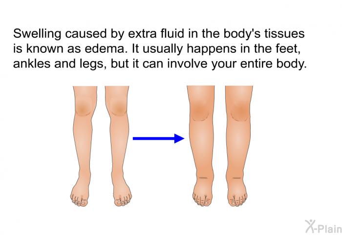 Swelling caused by extra fluid in the body's tissues is known as edema. It usually happens in the feet, ankles and legs, but it can involve your entire body.