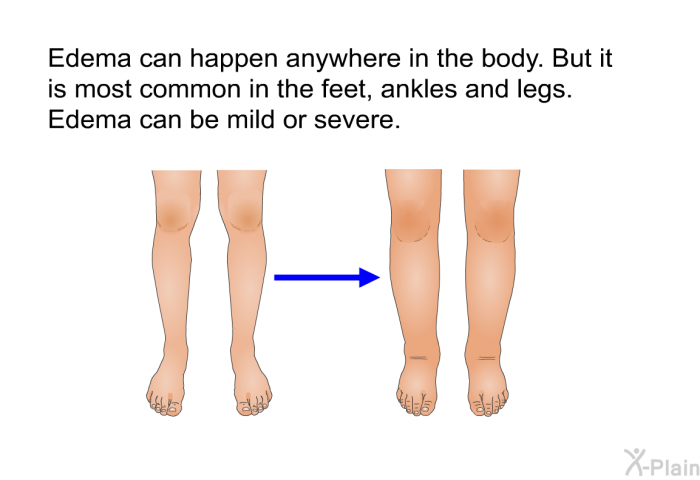 Edema can happen anywhere in the body. But it is most common in the feet, ankles and legs. Edema can be mild or severe.
