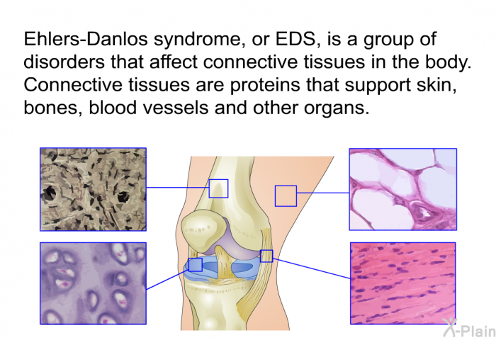Ehlers-Danlos syndrome, or EDS, is a group of disorders that affect connective tissues in the body. Connective tissues are proteins that support skin, bones, blood vessels and other organs.