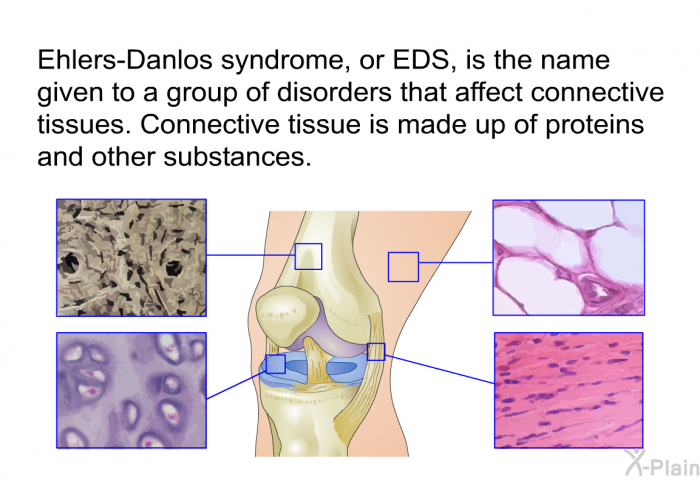 Ehlers-Danlos syndrome, or EDS, is the name given to a group of disorders that affect connective tissues. Connective tissue is made up of proteins and other substances.