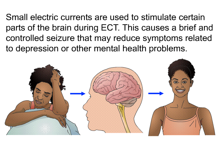 Small electric currents are used to stimulate certain parts of the brain during ECT. This causes a brief and controlled seizure that may reduce symptoms related to depression or other mental health problems.