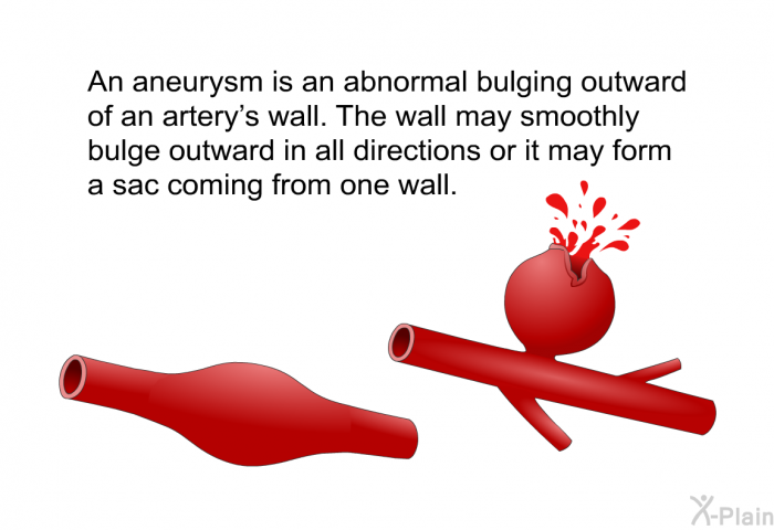 An aneurysm is an abnormal bulging outward of an artery's wall. The wall may smoothly bulge outward in all directions or it may form a sac coming from one wall.