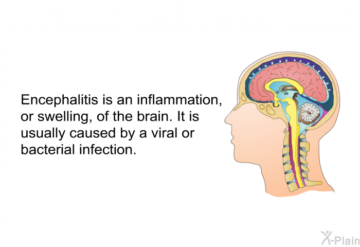 Encephalitis is an inflammation, or swelling, of the brain. It is usually caused by a viral or bacterial infection.