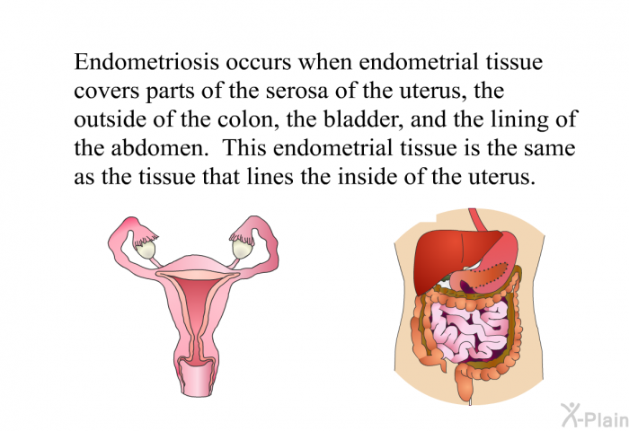 Endometriosis occurs when endometrial tissue covers parts of the serosa of the uterus, the outside of the colon, the bladder and the lining of the abdomen. This endometrial tissue is the same as the tissue that lines the inside of the uterus.