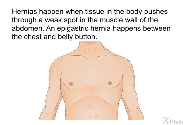 Hernias happen when tissue in the body pushes through a weak spot in the muscle wall of the abdomen. An epigastric hernia happens between the chest and belly button.