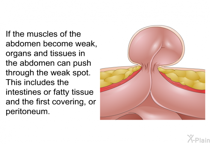 If the muscles of the abdomen become weak, organs and tissues in the abdomen can push through the weak spot. This includes the intestines or fatty tissue and the first covering, or peritoneum.