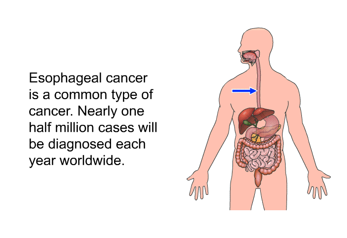 Esophageal cancer is a common type of cancer. Nearly one half million cases will be diagnosed each year worldwide.