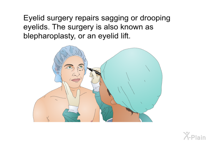 Eyelid surgery repairs sagging or drooping eyelids. The surgery is also known as blepharoplasty, or an eyelid lift.