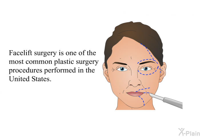 Facelift surgery is one of the most common plastic surgery procedures performed in the United States.