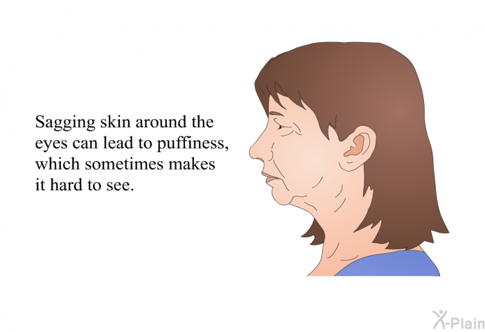 Sagging skin around the eyes can lead to puffiness, which sometimes makes it hard to see.