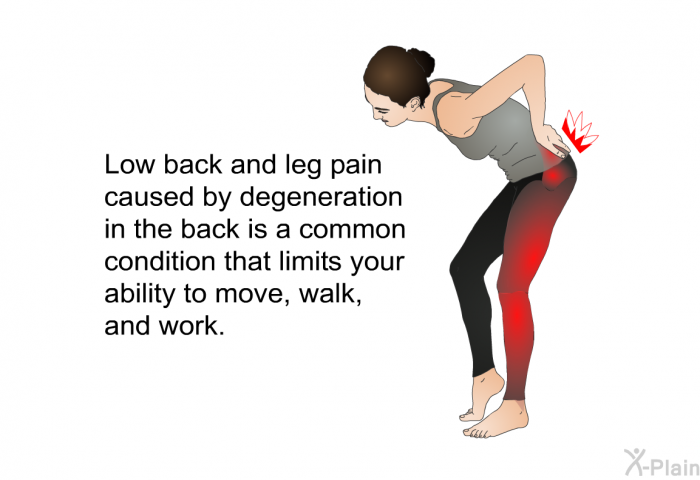 Low back and leg pain caused by degeneration in the back is a common condition that limits your ability to move, walk, and work.