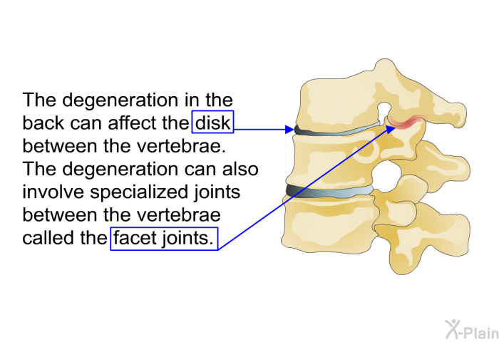 The degeneration in the back can affect the disk between the vertebrae. The degeneration can also involve specialized joints between the vertebrae called the facet joints.