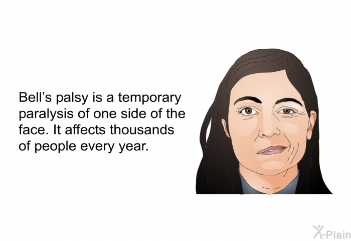 Bell's palsy is a temporary paralysis of one side of the face. It affects thousands of people every year.