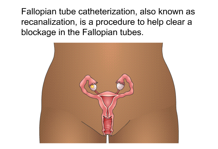 Fallopian tube catheterization, also known as recanalization, is a procedure to help clear a blockage in the Fallopian tubes.