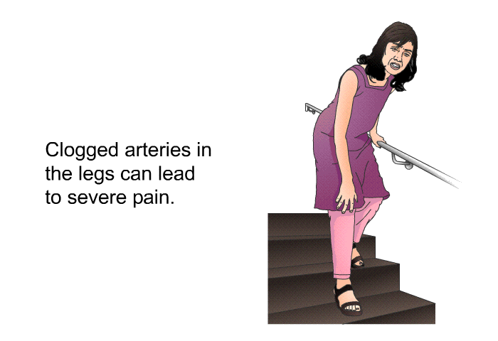Clogged arteries in the legs can lead to severe pain.