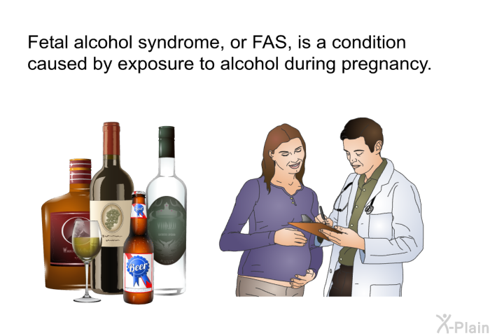 Fetal alcohol syndrome, or FAS, is a condition caused by exposure to alcohol during pregnancy.