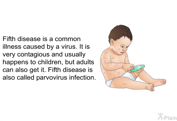Fifth disease is a common illness caused by a virus. It is very contagious and usually happens to children, but adults can also get it. Fifth disease is also called parvovirus infection.
