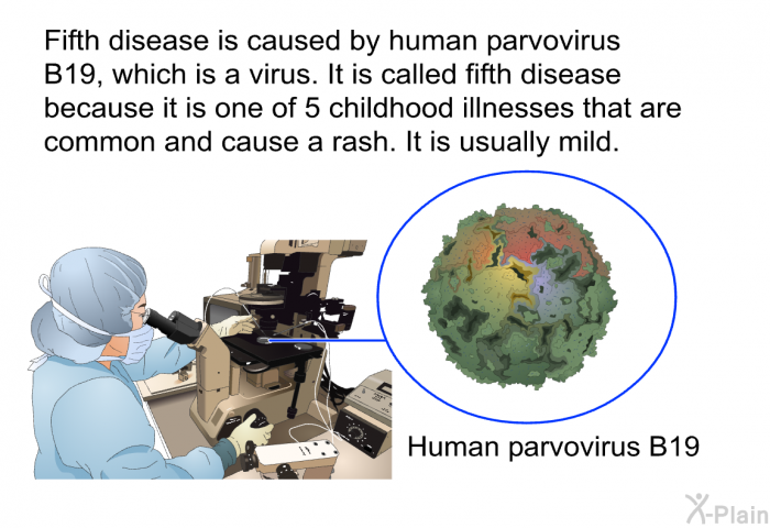 Fifth disease is caused by human parvovirus B19, which is a virus. It is called fifth disease because it is one of 5 childhood illnesses that are common and cause a rash. It is usually mild.