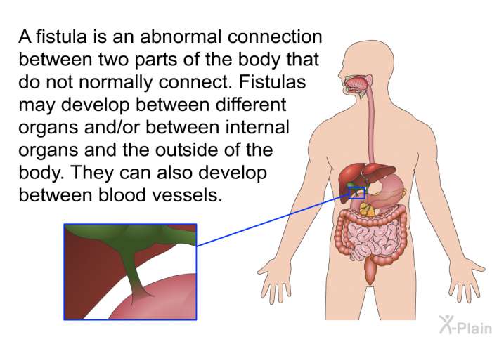 A fistula is an abnormal connection between two parts of the body that do not normally connect. Fistulas may develop between different organs and/or between internal organs and the outside of the body. They can also develop between blood vessels.