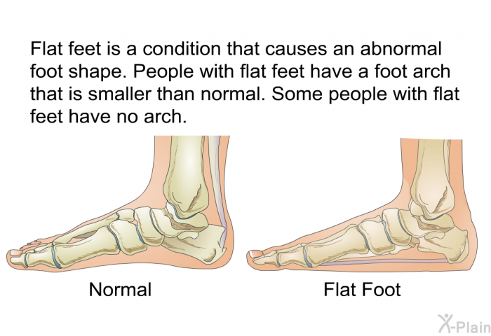Flat feet is a condition that causes an abnormal foot shape. People with flat feet have a foot arch that is smaller than normal. Some people with flat feet have no arch.