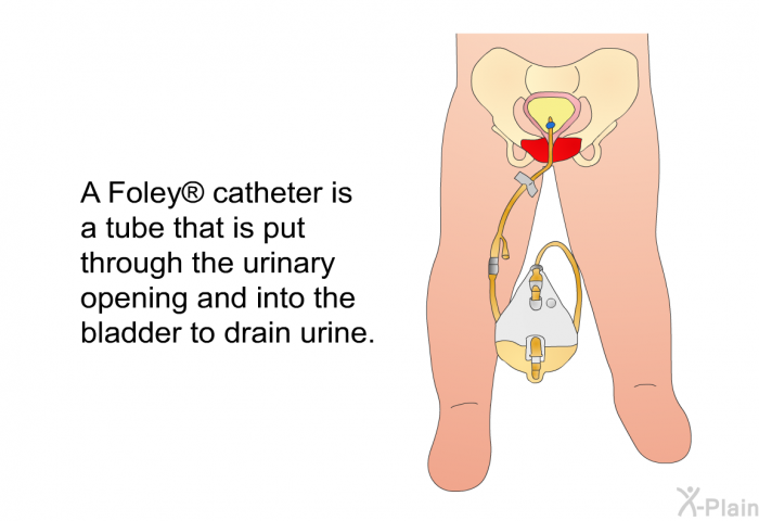 A Foley  catheter is a tube that is put through the urinary opening and into the bladder to drain urine.