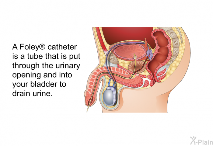 A Foley<SUP> </SUP> catheter is a tube that is put through the urinary opening and into your bladder to drain urine.