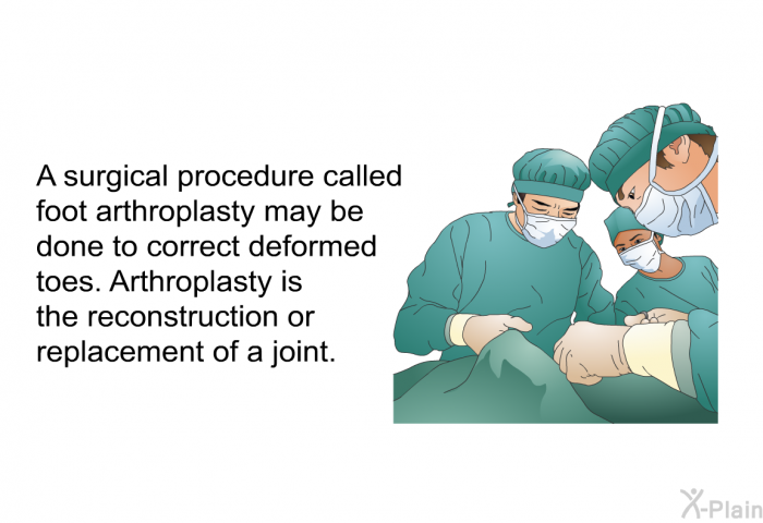 A surgical procedure called foot arthroplasty may be done to correct deformed toes. Arthroplasty is the reconstruction or replacement of a joint.