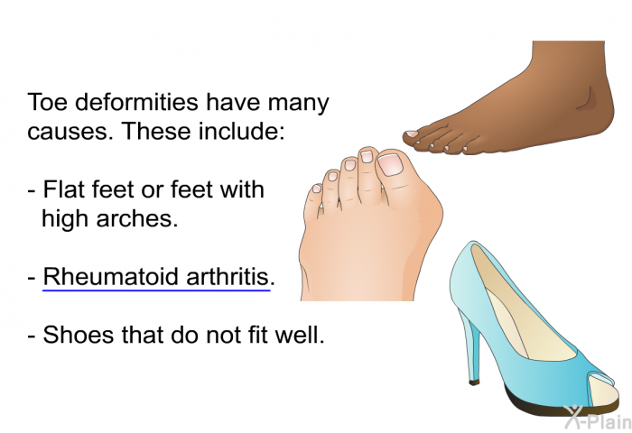 Toe deformities have many causes. These include:  Flat feet or feet with high arches. Rheumatoid arthritis. Shoes that do not fit well.