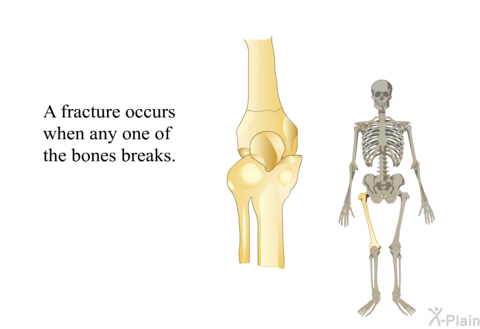A fracture occurs when any one of the bones breaks.