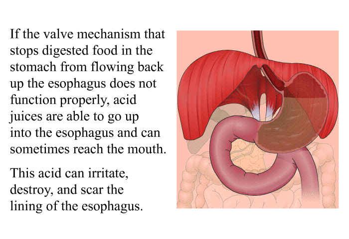 If the valve mechanism that stops digested food in the stomach from flowing back up the esophagus does not function properly, acid juices are able to go up into the esophagus and can sometimes reach the mouth. This acid can irritate, destroy, and scar the lining of the esophagus.