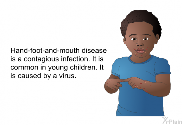 Hand-foot-and-mouth disease is a contagious infection. It is common in young children. It is caused by a virus.