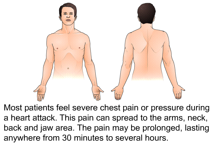 Most patients feel severe chest pain or pressure during a heart attack. This pain can spread to the arms, neck, back and jaw area. The pain may be prolonged, lasting anywhere from 30 minutes to several hours.