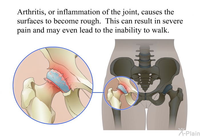 Arthritis, or inflammation of the joint, causes the surfaces to become rough. This can result in severe pain and may even lead to the inability to walk.