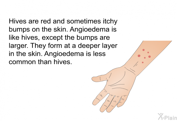 Hives are red and sometimes itchy bumps on the skin. Angioedema is like hives, except the bumps are larger. They form at a deeper layer in the skin. Angioedema is less common than hives.