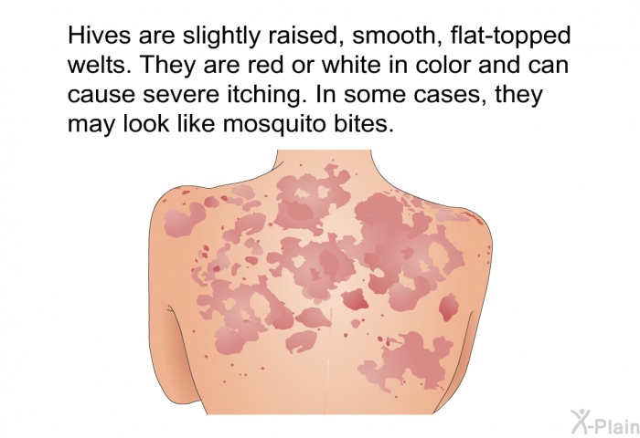 Hives are slightly raised, smooth, flat-topped welts. They are red or white in color and can cause severe itching. In some cases, they may look like mosquito bites.