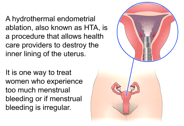 A hydrothermal endometrial ablation, also known as HTA, is a procedure that allows health care providers to destroy the inner lining of the uterus. It is one way to treat women who experience too much menstrual bleeding or if menstrual bleeding is irregular.