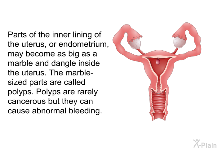 Parts of the inner lining of the uterus, or endometrium, may become as big as a marble and dangle inside the uterus. The marble-sized parts are called polyps. Polyps are rarely cancerous but they can cause abnormal bleeding.