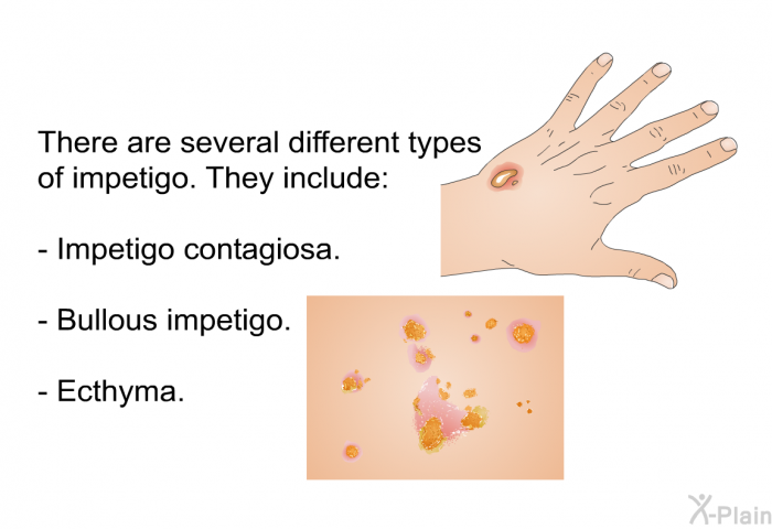 There are several different types of impetigo. They include:  Impetigo contagiosa. Bullous impetigo. Ecthyma.