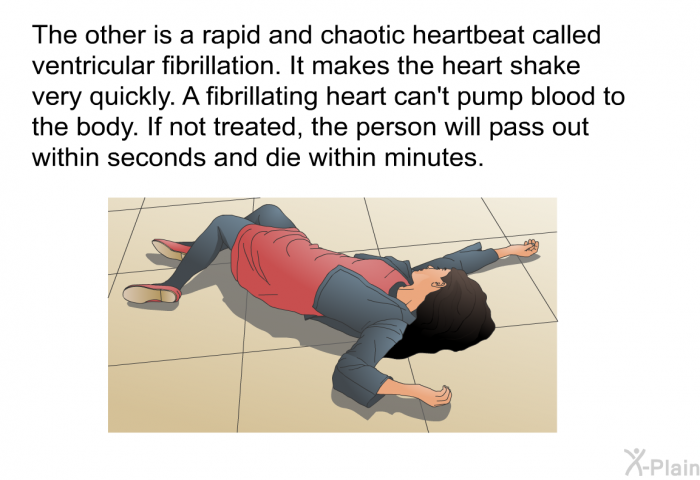 The other is a rapid and chaotic heartbeat called ventricular fibrillation. It makes the heart shake very quickly. A fibrillating heart can't pump blood to the body. If not treated, the person will pass out within seconds and die within minutes.