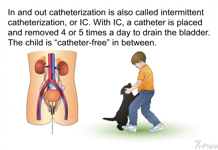 In and out catheterization is also called intermittent catheterization, or IC. With IC, a catheter is placed and removed 4 or 5 times a day to drain the bladder. The child is “catheter-free” in between.