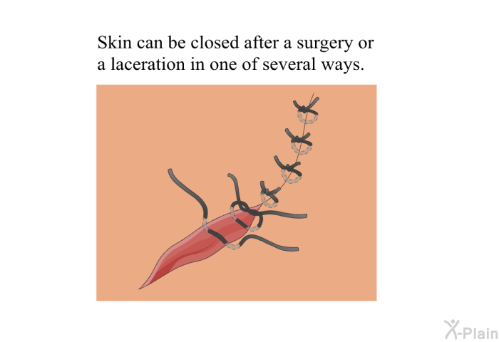 Skin can be closed after a surgery or a laceration in one of several ways.