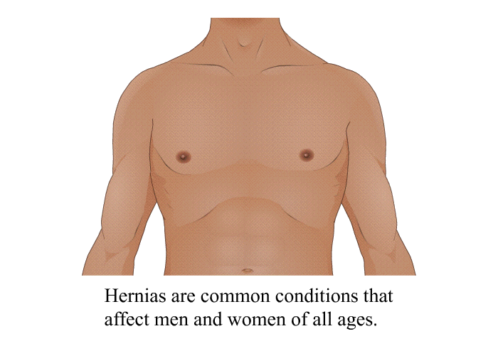 Hernias are common conditions that affect men and women of all ages.