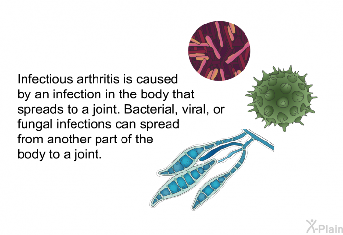 Infectious arthritis is caused by an infection in the body that spreads to a joint. Bacterial, viral, or fungal infections can spread from another part of the body to a joint.