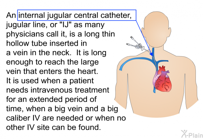 PatEdu Internal Jugular Central Catheter