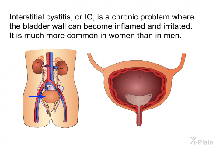 Interstitial cystitis, or IC, is a chronic problem where the bladder wall can become inflamed and irritated. It is much more common in women than in men.