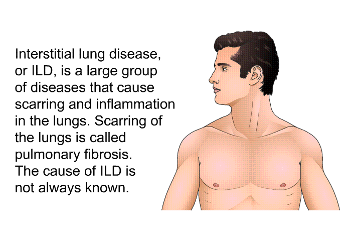 Interstitial lung disease, or ILD, is a large group of diseases that cause scarring and inflammation in the lungs. Scarring of the lungs is called pulmonary fibrosis. The cause of ILD is not always known.