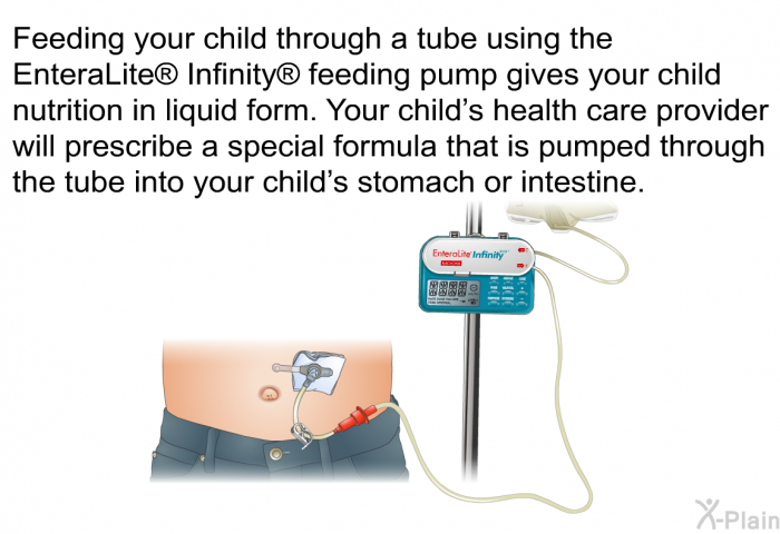 Feeding your child through a tube using the EnteraLite  Infinity  feeding pump gives your child nutrition in liquid form. Your child's health care provider will prescribe a special formula that is pumped through the tube into your child's stomach or intestine.